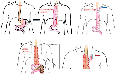 JCM | Free Full-Text | A Comparison of Different Types of Esophageal ...