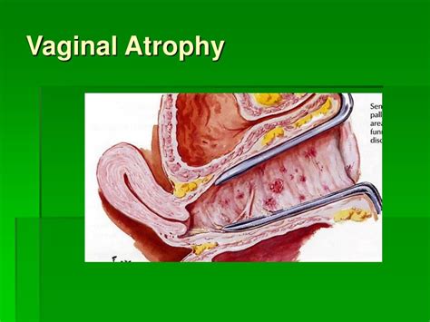 PPT - The Menopause PowerPoint Presentation, free download - ID:437412