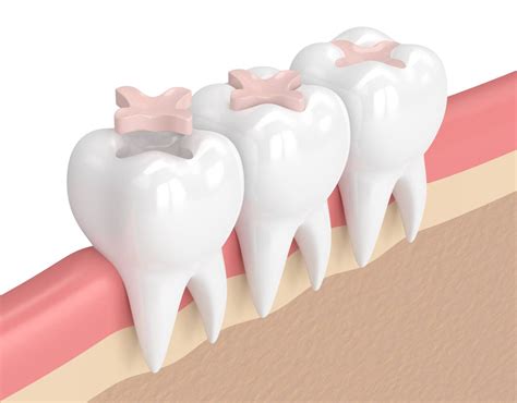 Everything You Need to Know about Dental Inlay - Dean Armstrong DDS