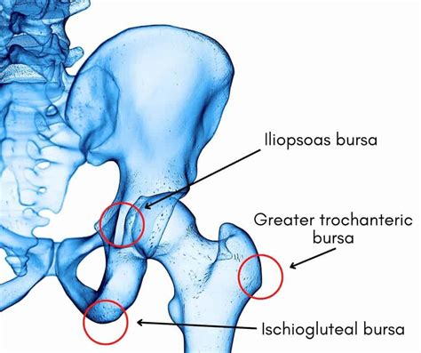 Hip Bursitis: Symptoms, Causes and Best Exercises for Pain Relief