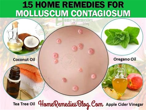 15 Home Remedies For Molluscum Contagiosum Natural Treatment - Home ...