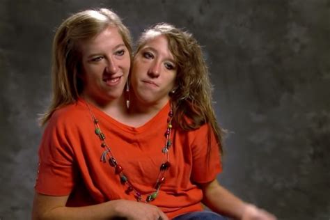 These Siamese Twins Have A Heartfelt Message That The World Needs To Hear