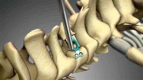 Laminoplasty likely a valid option for spinal cord decompression ...