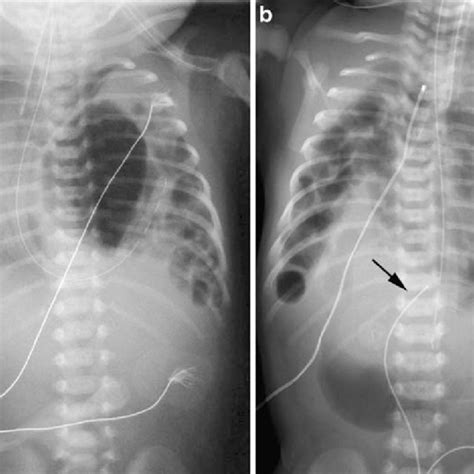 Neonatal Bochdalek hernia. a A 1-day-old boy with left Bochdalek ...