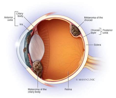 What is ocular melanoma? - Mayo Clinic News Network