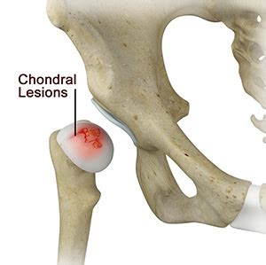 Chondral Lesions Injuries Houston | Labral Tears Pearland | Posterior ...