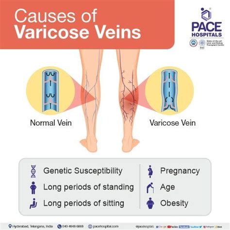 Varicose Veins – Symptoms, Causes, Complications and Treatment