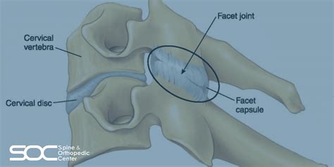 Facet Joint Syndrome | Facet Disease | Spine & Orthopedic Center