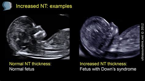 Nuchal translucency (NT) - YouTube