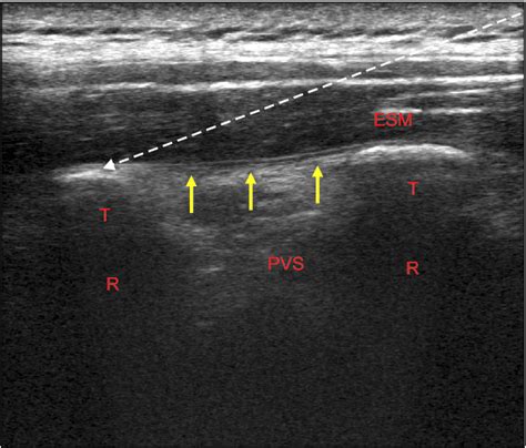 Lumbar Erector Spinae Plane Block