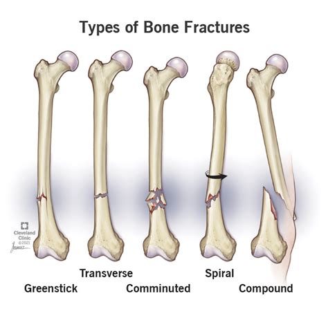 Bone Fractures: Types, Symptoms Treatment, 56% OFF