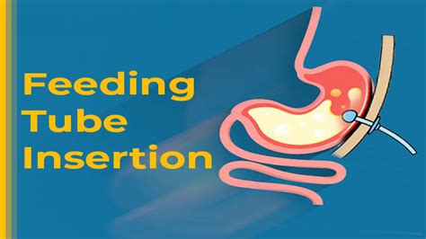 Feeding Tube Insertion (Gastrostomy): Types, Risks, Procedure And ...