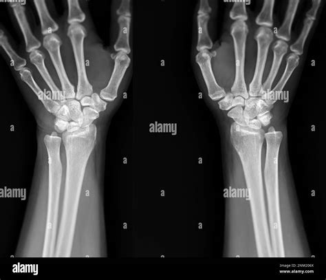 X-ray image of wrist joint front view of normal wrist joint Stock Photo ...