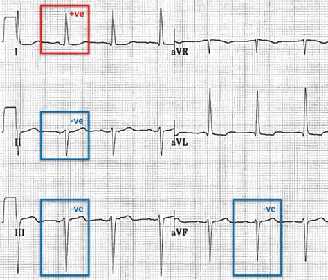 Left Anterior Fascicular Block (LAFB) • LITFL • ECG Library Diagnosis