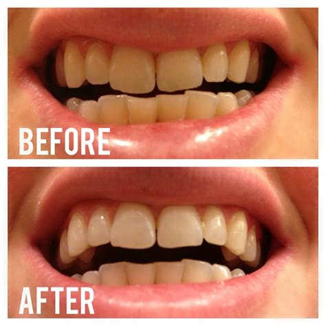 Does Activated Charcoal Teeth Whitening Works? You Need to Know This