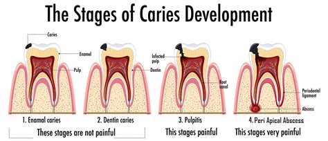 Sequelae of Dental Caries – Dr. Praveen's Dental