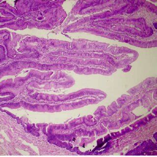 The pedunculated polyp is shown with villous structures lined by tall ...