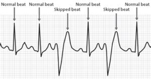 How Does Stress Cause a “Skipped” Heartbeat? » Scary Symptoms