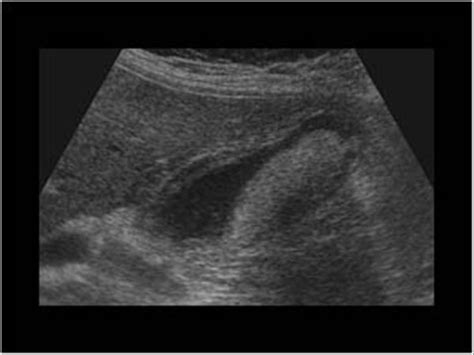 Abdomen and retroperitoneum | 1.2 Gallbladder and bile ducts : Case 1.2 ...