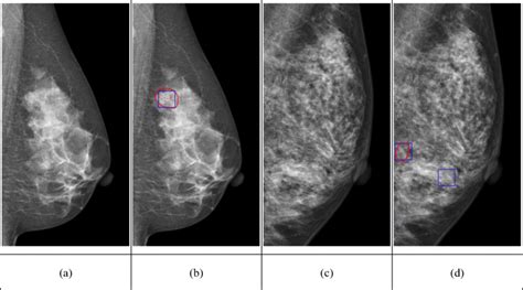 MCC detection results. (a) The original mammogram. (b) The ...