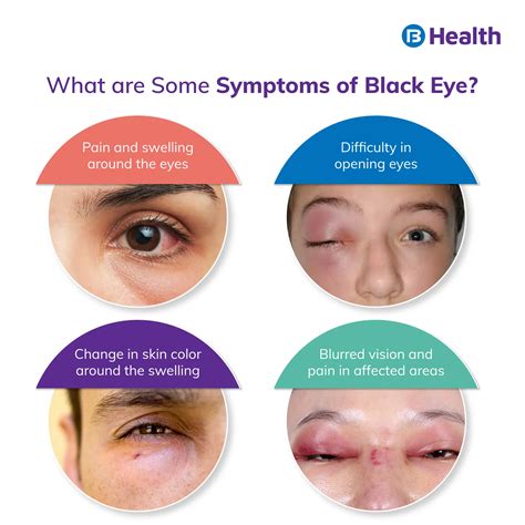 Black Eye: Causes, Symptoms, Home Remedies, and Diagnosis