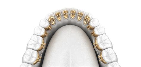 The Pros and Cons of Lingual Braces :: Guilford Orthodontics