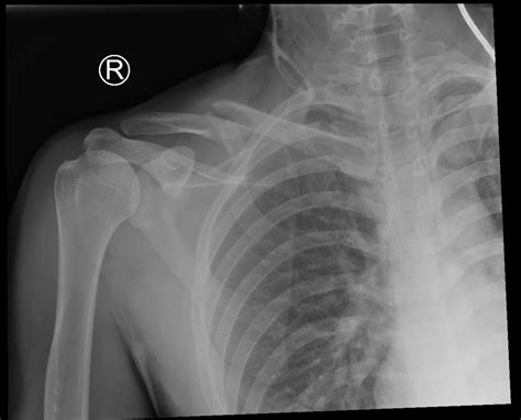 Adult Clavicular Fracture Case Report - JETem