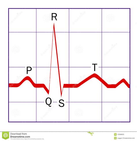 Normal Ecg Tracing