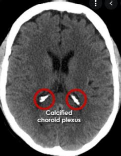 Cranial, Cerebral, and Upper Airway Radiology Flashcards | Quizlet