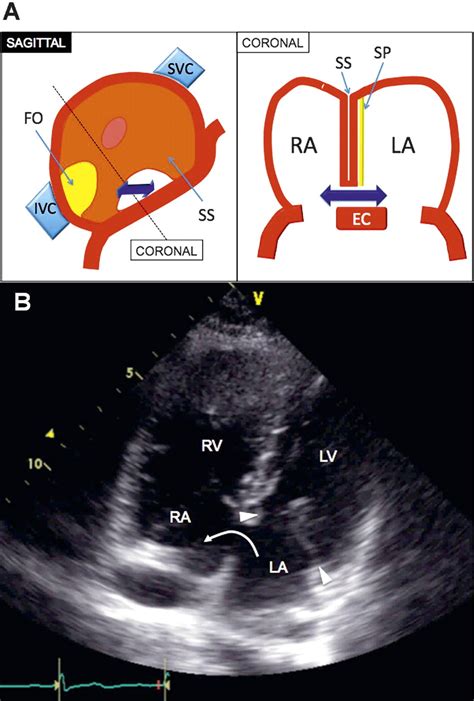 Imaging of atrial septal defects: echocardiography and CT correlation ...