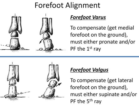 Forefoot pathologies - FFVR and FFVL Flashcards | Quizlet