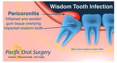 Abscessed Wisdom Tooth Extraction