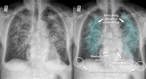 Pulmonary Edema X Ray Butterfly Pattern