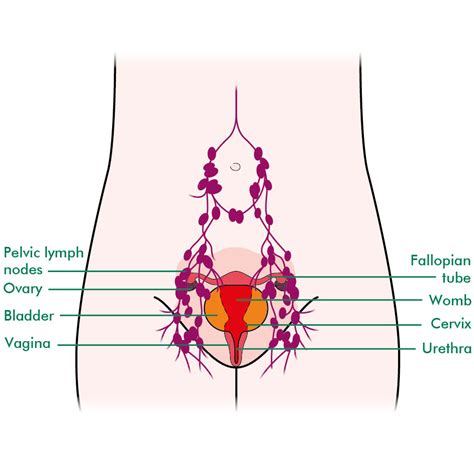 Cervical Cancer Lymph Nodes