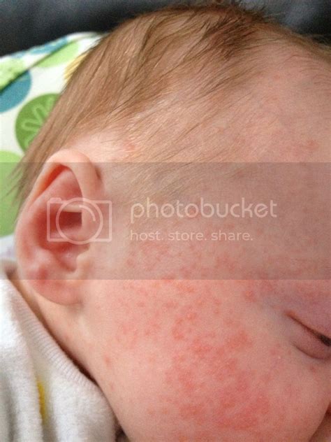 Baby acne?? - BabyCenter