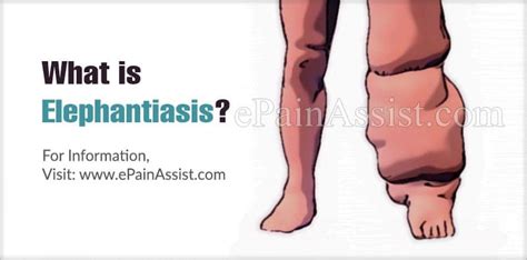 Elephantiasis|Causes|Symptoms|Treatment|Diagnosis