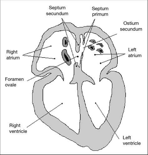 The adult heart with a patent foramen ovale in cross-sectional plane ...