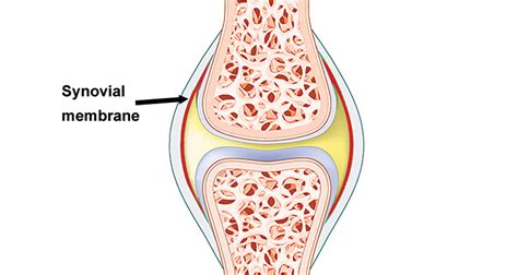 Can Synovitis Be Caused By Trauma - mapasebab