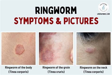 Ringworm Pictures & Symptoms: What does ringworm look like?