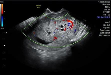 Partial Molar Pregnancy