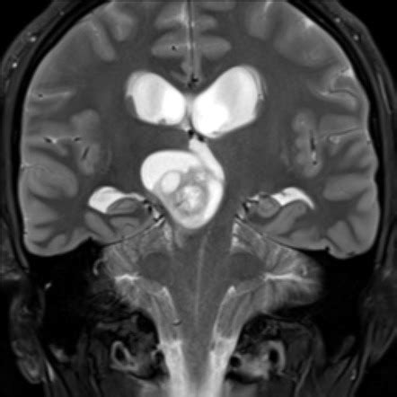 Pilocytic astrocytoma | Radiology Reference Article | Radiopaedia.org