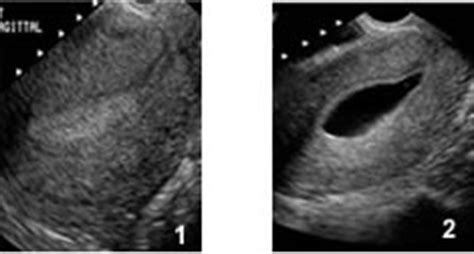 Infertility Diagnostic Procedures - Treatmenet of Infertility