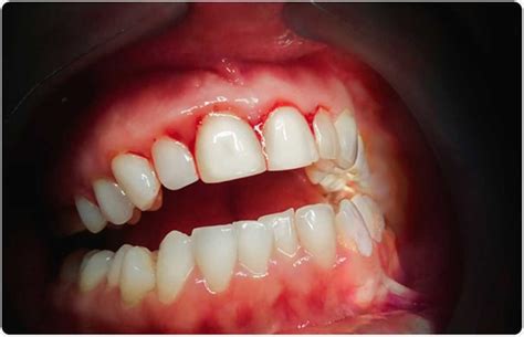 Bleeding gums? It may be a sign of Vitamin C deficiency