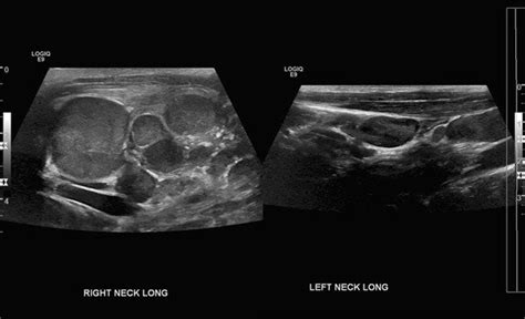 Swollen Lymph Nodes In Neck Ultrasound