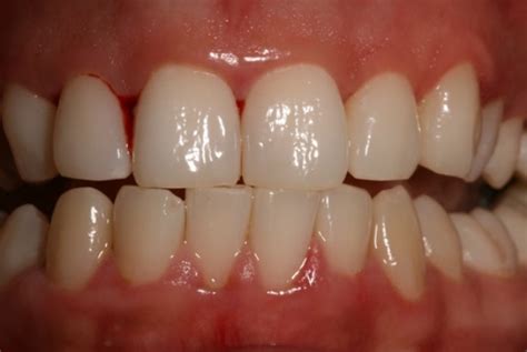 Sore Gums: Causes, Symptoms and Treatment - Headgear Braces