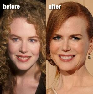 Nicole Kidman Before And After Plastic Surgery Pictures | 2018 Plastic ...