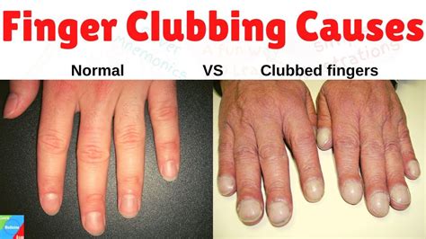 Finger Clubbing Grading