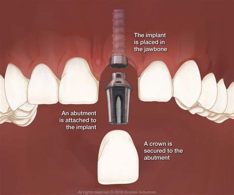 Dental Implants Washington, DC - Implant Dentistry - RUSK, THORNTON ...