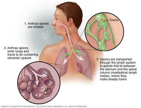 Anthrax - Symptoms and causes - Mayo Clinic