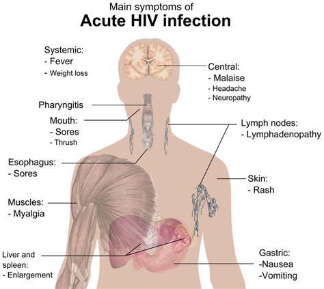 Acute retroviral syndrome causes, symptoms, diagnosis & treatment